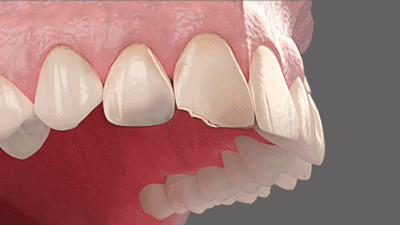 Faccette-dentali-elite-veneers-italia